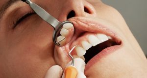 Як часто потрібно проводити професійну гігієну порожнини рота