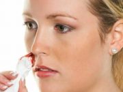 Причини кровотечі з носа