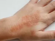 Чому виникає контактний дерматит?