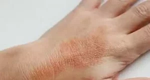 Чому виникає контактний дерматит?