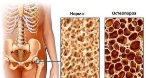 Остеопороз – хвороба будь-якого віку, профілактика і лікування