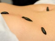 Від яких хвороб можуть вилікувати п’явки?