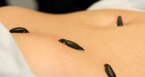 Від яких хвороб можуть вилікувати п’явки?