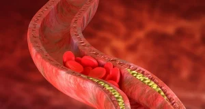 Як знизити холестерин домашніми засобами