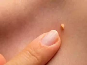 Чому з’являються папіломи та бородавки: основні причини