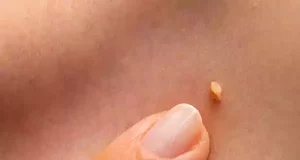 Чому з’являються папіломи та бородавки: основні причини