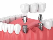 Що таке імплантація зуба та де її провести