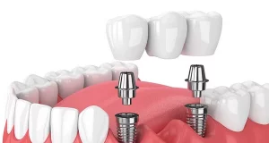 Що таке імплантація зуба та де її провести