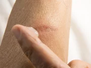 Домашні засоби від опіків