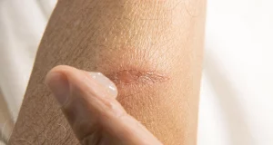 Домашні засоби від опіків