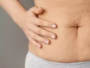 Комплексний посібник з розуміння та усунення розтяжок на животі у чоловіків і жінок