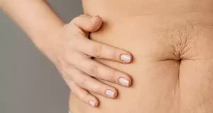 Комплексний посібник з розуміння та усунення розтяжок на животі у чоловіків і жінок