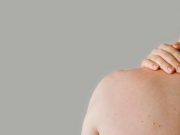 Причини появи прищів на спині та способи боротьби з ними